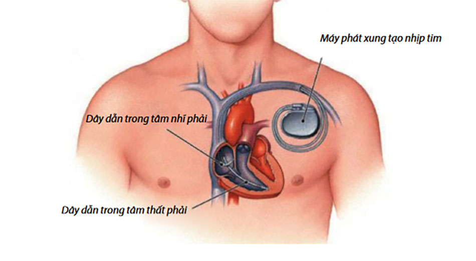 pacemakers-vn-2