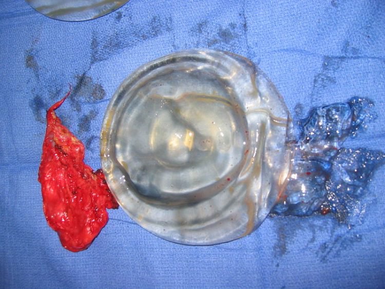 ruptured-implant-750x563