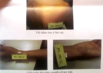 Dấu tích “đòn oan” với một doanh nhân bị công an tạm giữ