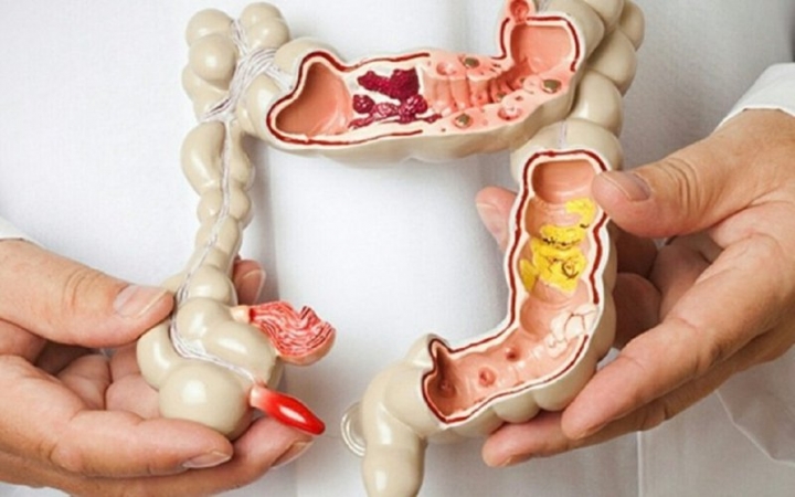 chua polyp dai trang bang dong y